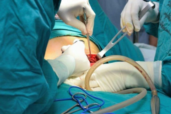 Fistula Treatment