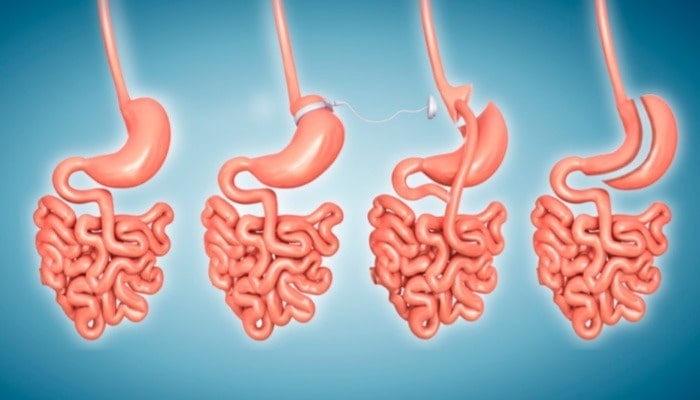 Best Bariatric Surgeon in Bangalore - Dr. Sumit Talwar