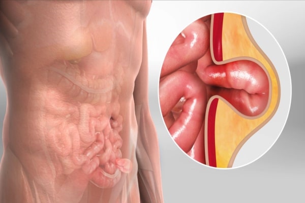 Complex abdominal hernia