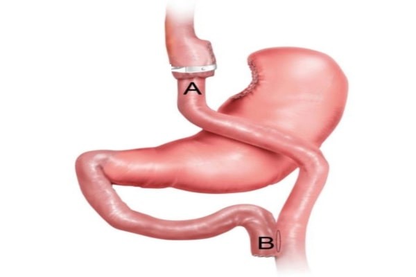 Laparoscopic Banded Gastric Bypass