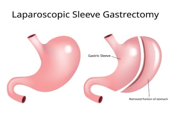 Laparoscopic Sleeve Gastrectomy
