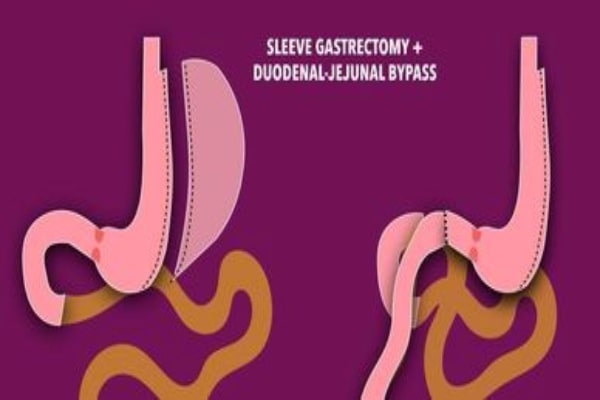 Sleeve Gastrectomy with Duodeno-Jejunostomy(DJB)