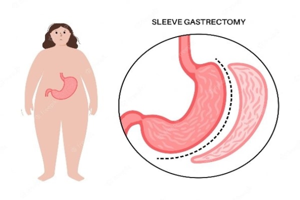 Robotic Sleeve Gastrectomy