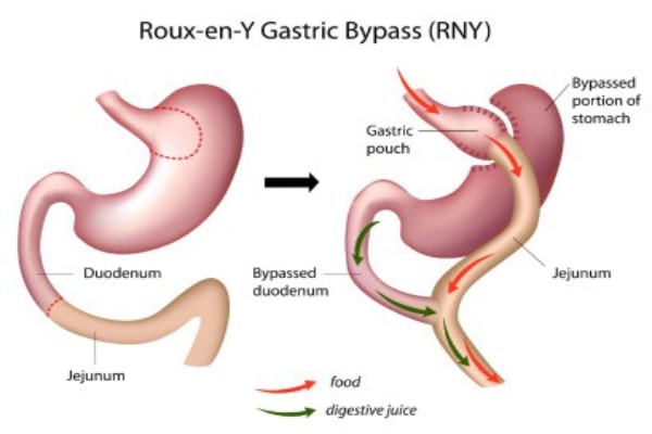 Laparoscopic  RnY Gastric Bypass (RYGB)