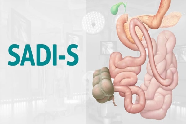 Laparoscopic SADI-S