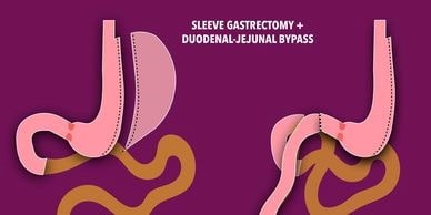 Best Sleeve Gastrectomy with Duodeno-Jejunal Bypass treatment  in whitefield bangalore