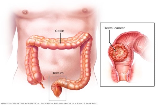 The Colon & Rectum
