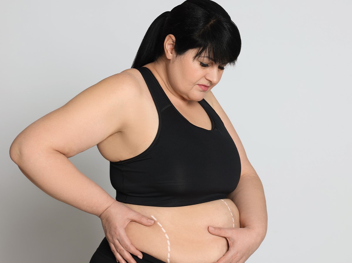 Bariatric Surgery