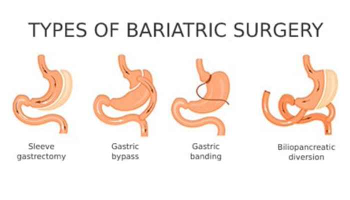 Types of Bariatric Procedures