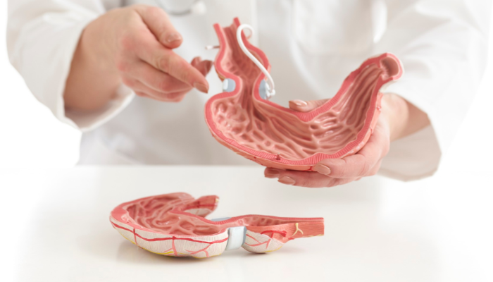 Understanding Dumping Syndrome After Gastric Bypass