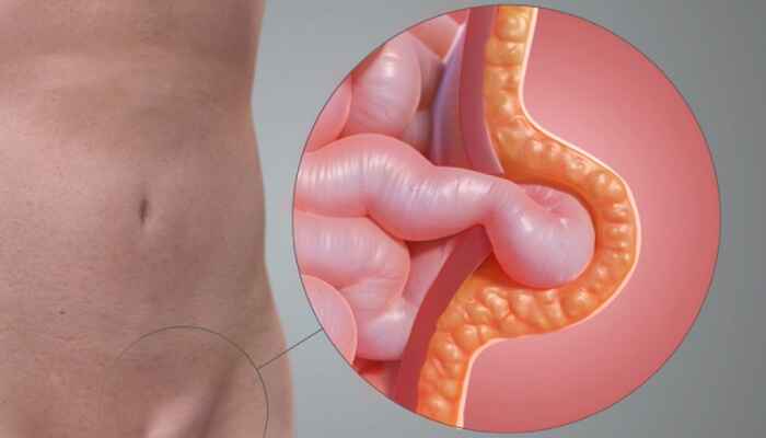 Unraveling the Complexities of Abdominal Hernias