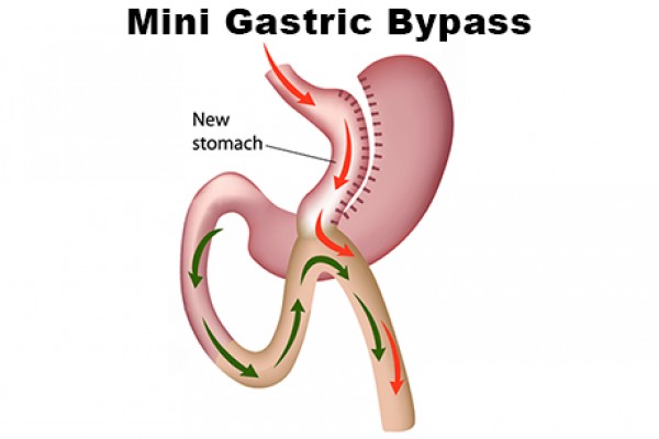 Laparoscopic  Mini Gastric Bypass (MGB)